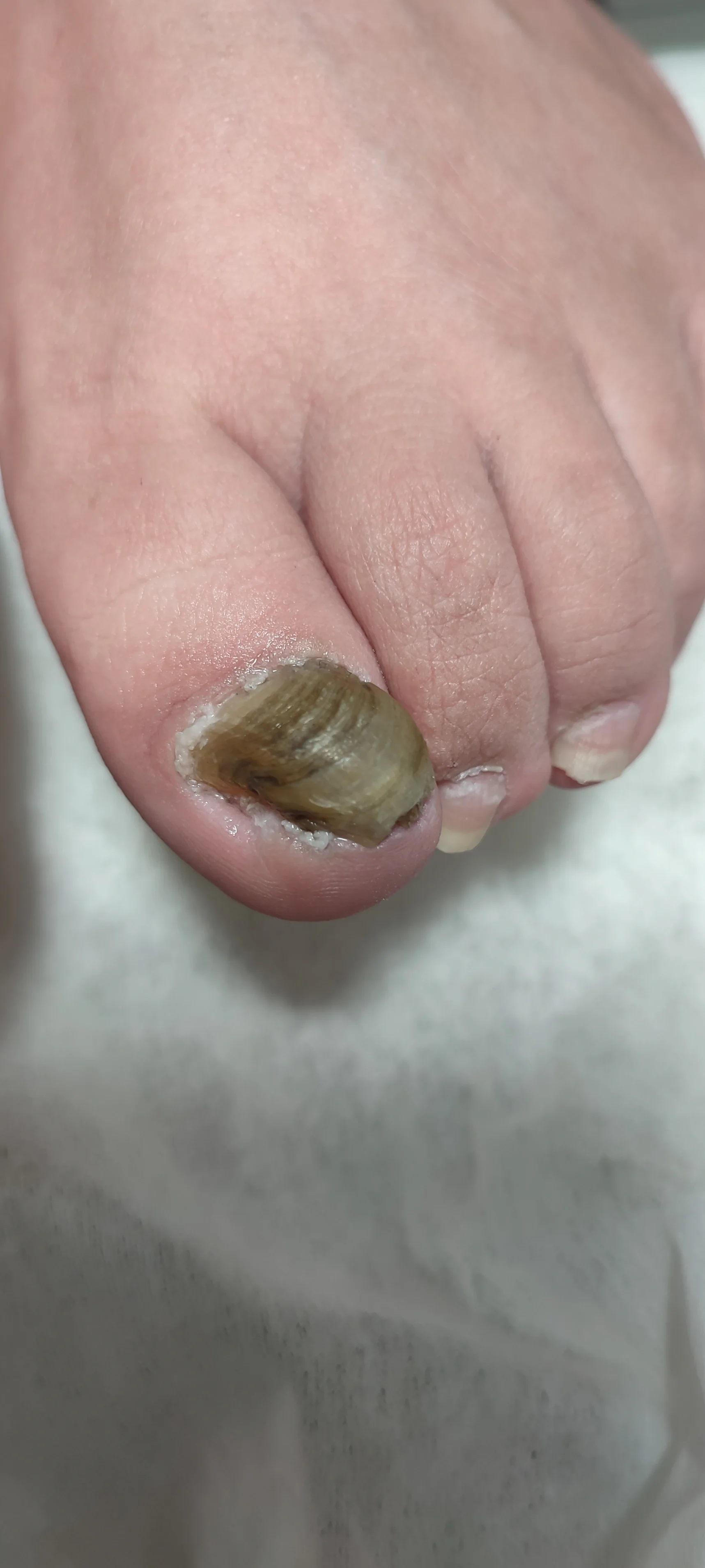 畸形趾甲,时刻影响着正常生活,每走一步都痛,终于被解决了,轻快的脚步