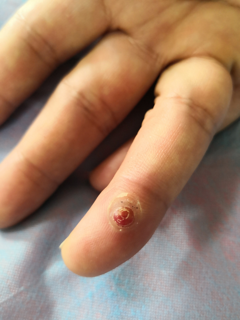 手指红色血管瘤样症状,是化脓性肉芽肿.