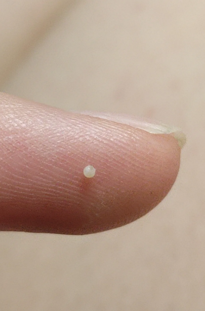 鼻头上挤出的白色东西最常见的是白头粉刺或者毛囊内皮脂