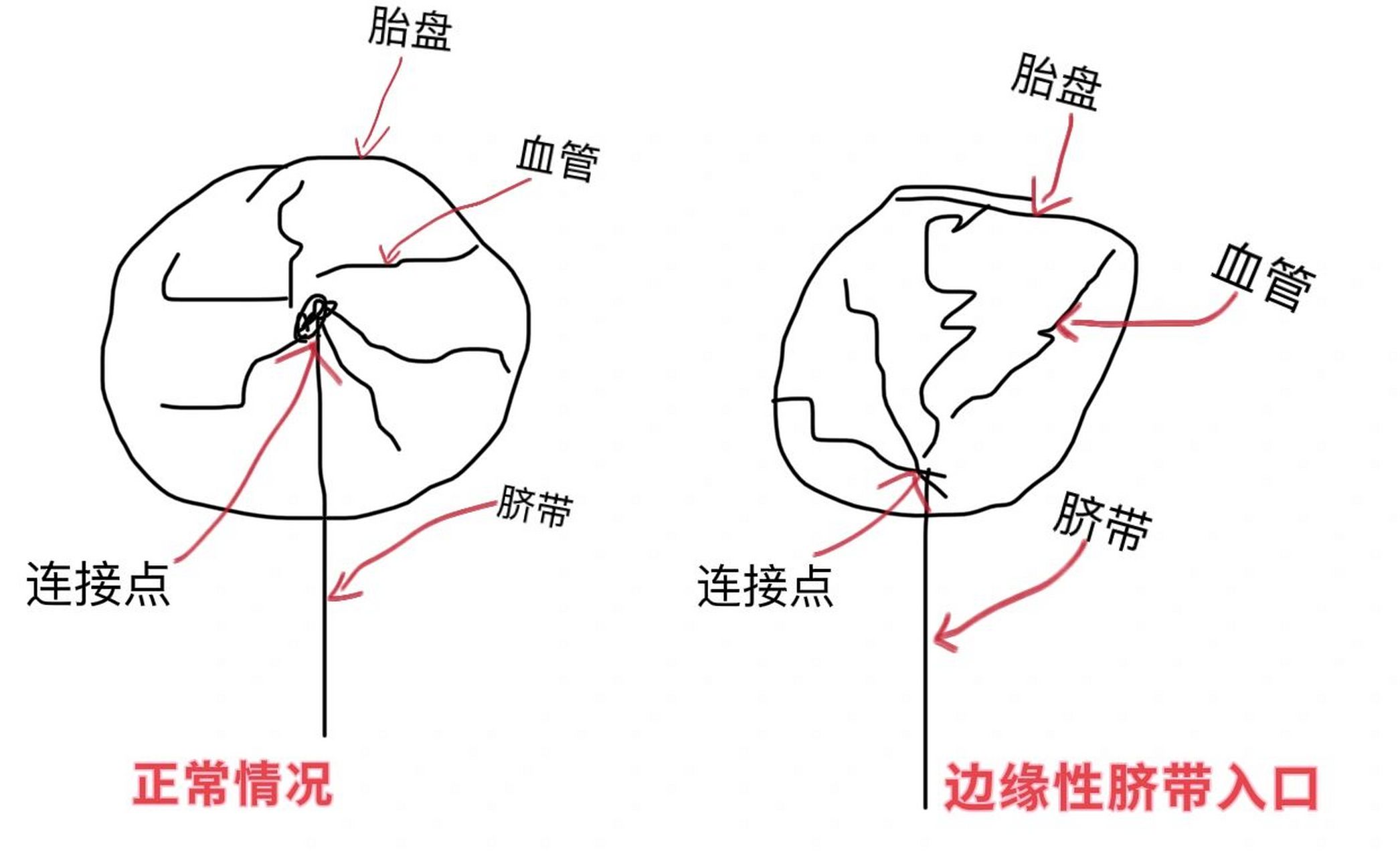 孕22 5w,边缘性脐带入口 今天去做了四维,其他一切都正常,顺利通过