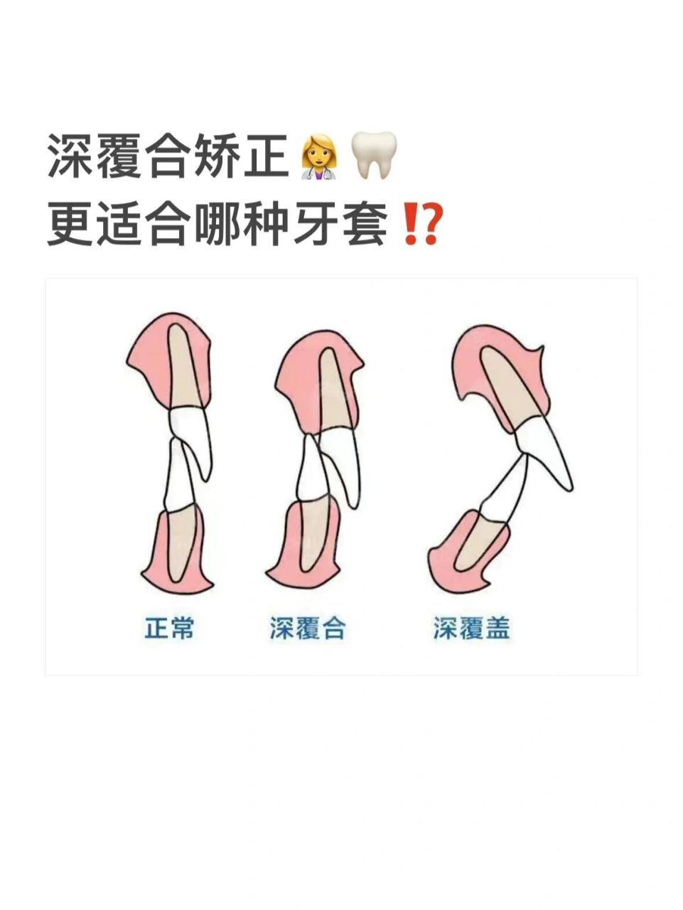 深覆合自我矫正方法图片