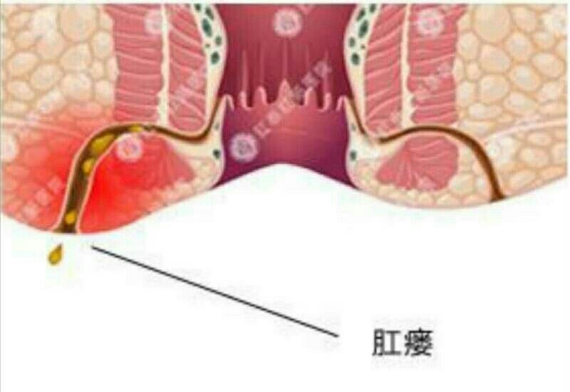 肛门周围有肉疙瘩,痒痒的,一定要小心肛痿 肛痿是肛门直肠痿的简称,是