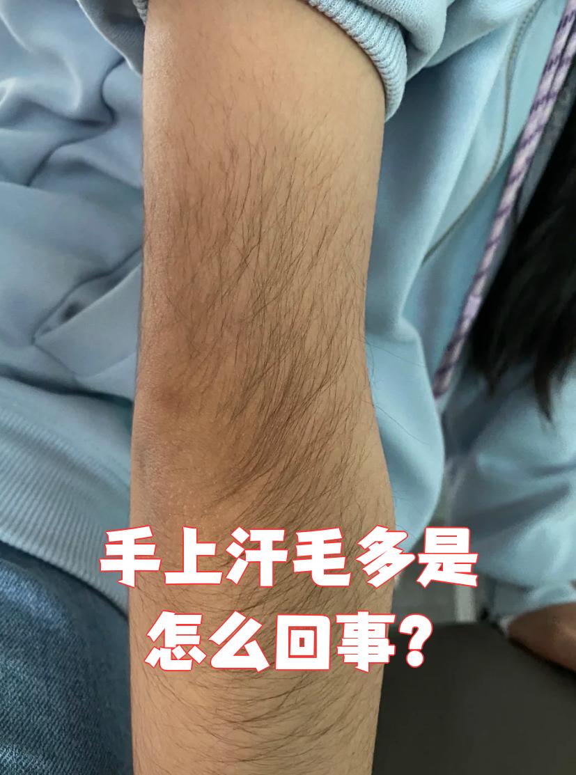 手上汗毛多通常和遗传,激素变化或者药物影响有关