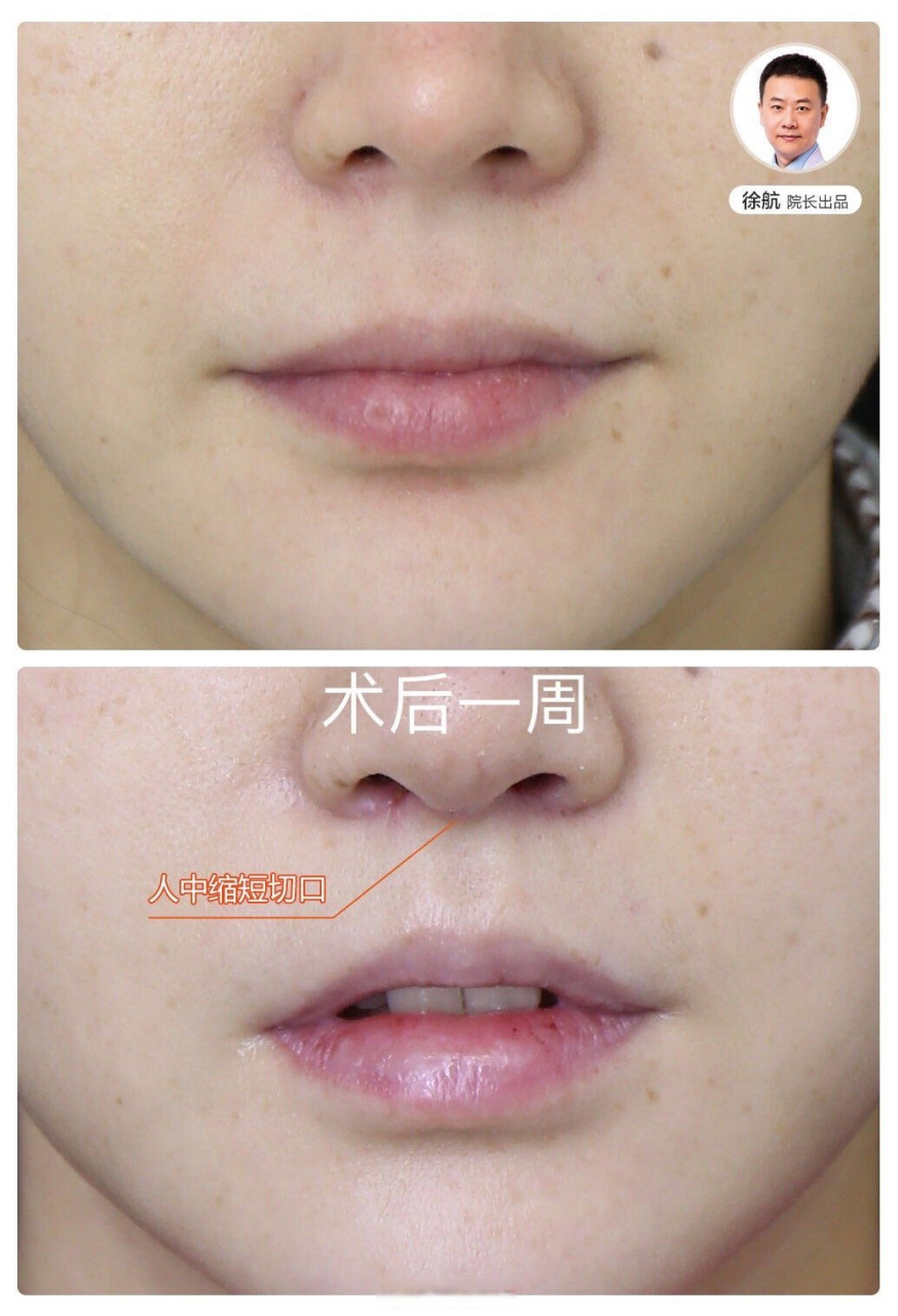 我们把传统的上唇人中缩短术式做了改良,这个方法好处是疤痕相对隐蔽