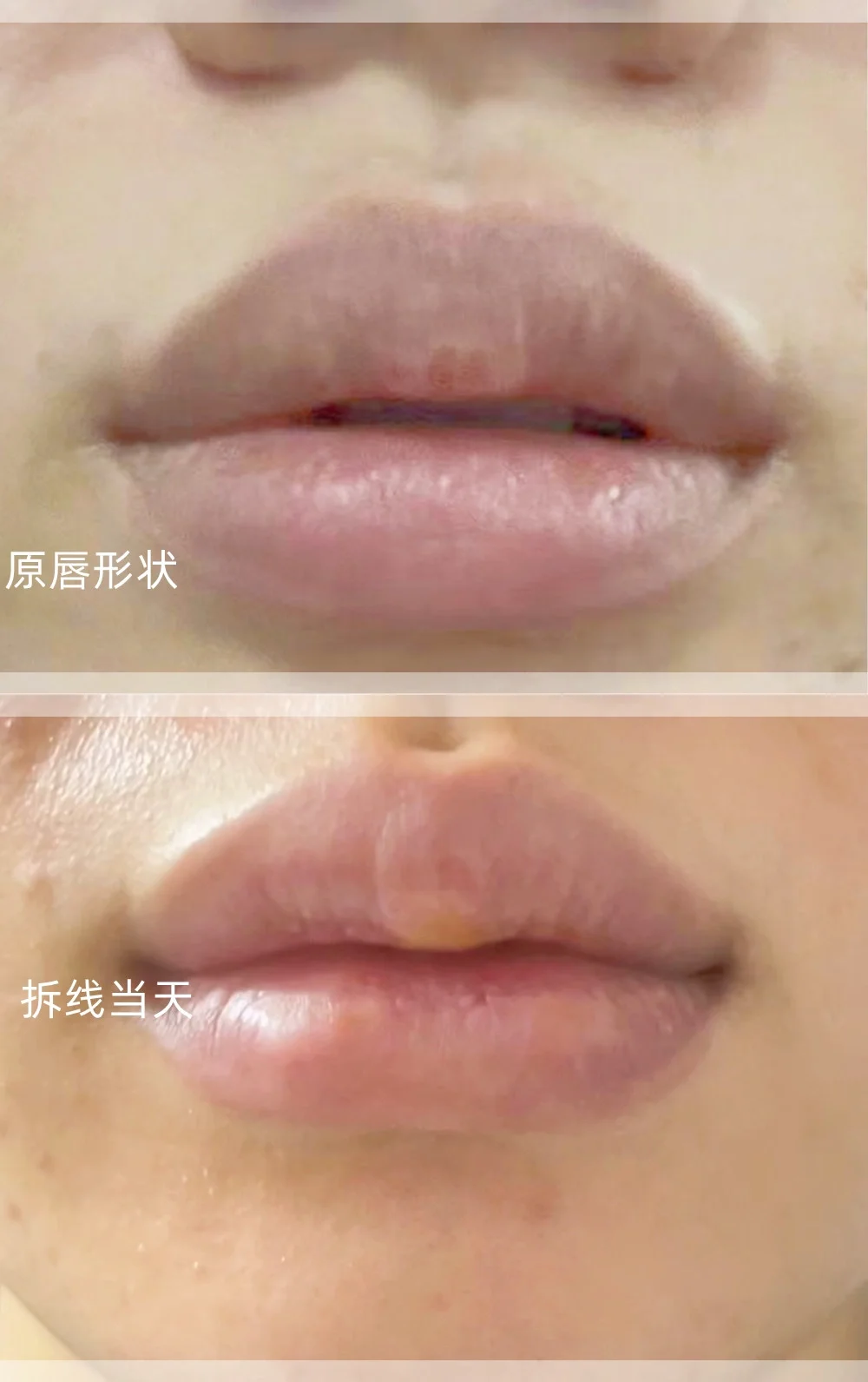 厚唇改薄 原唇对比 有很多姐妹想了解 ,我的原唇形 我原来的唇形就是