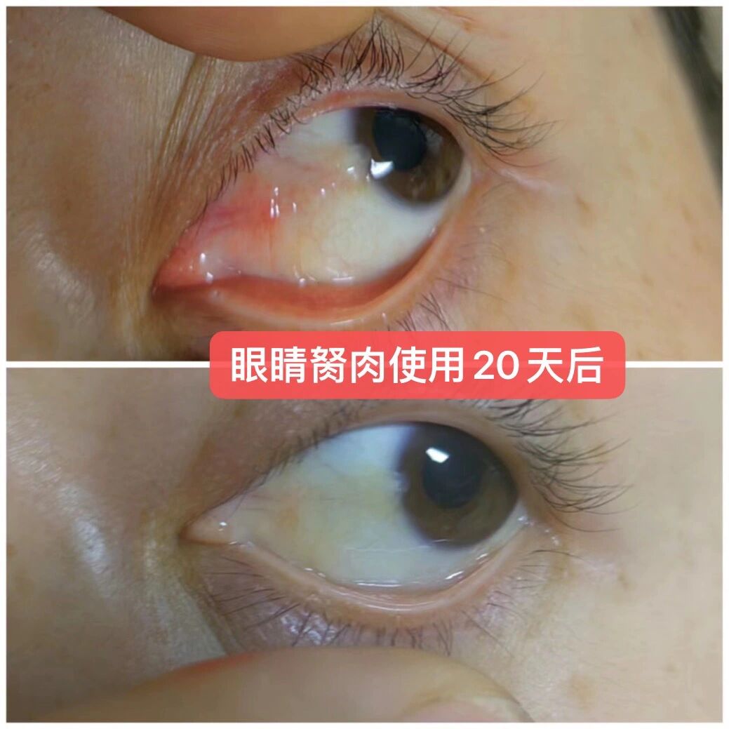 长在眼白上 悄咪咪望黑眼球 生长的存在 最终眼睛就看不清了