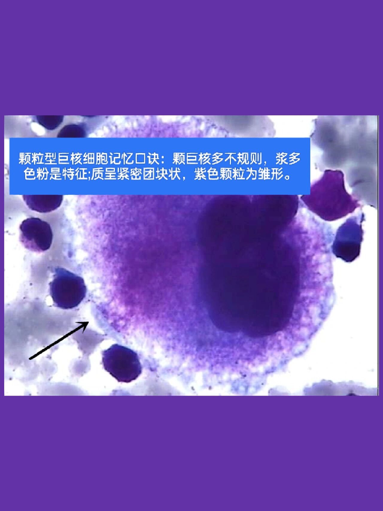 巨核细胞系统(巨核系)包括原始巨核细胞,幼稚巨核细胞,颗粒性巨核细胞