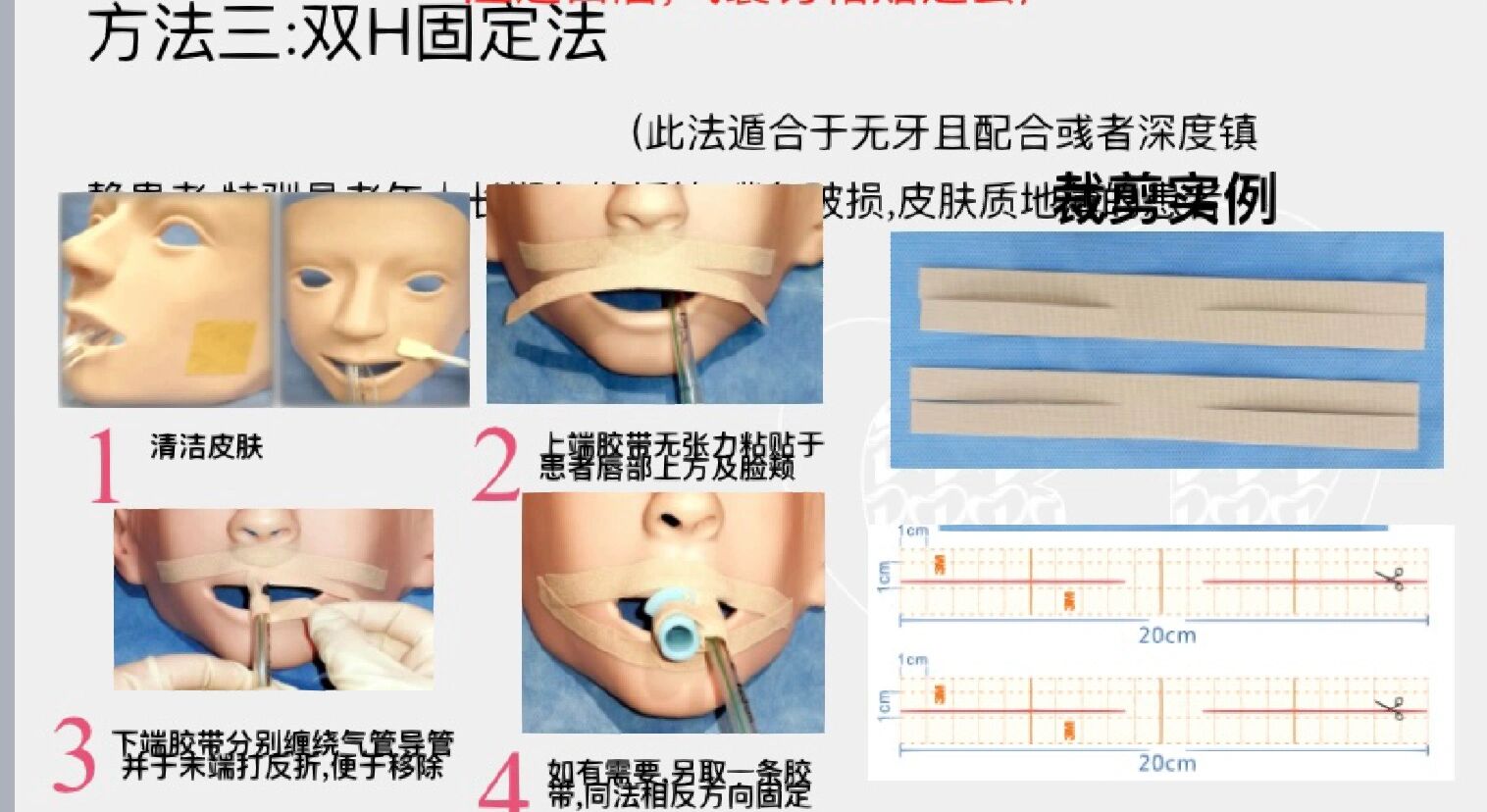 气管插管的固定方法图片