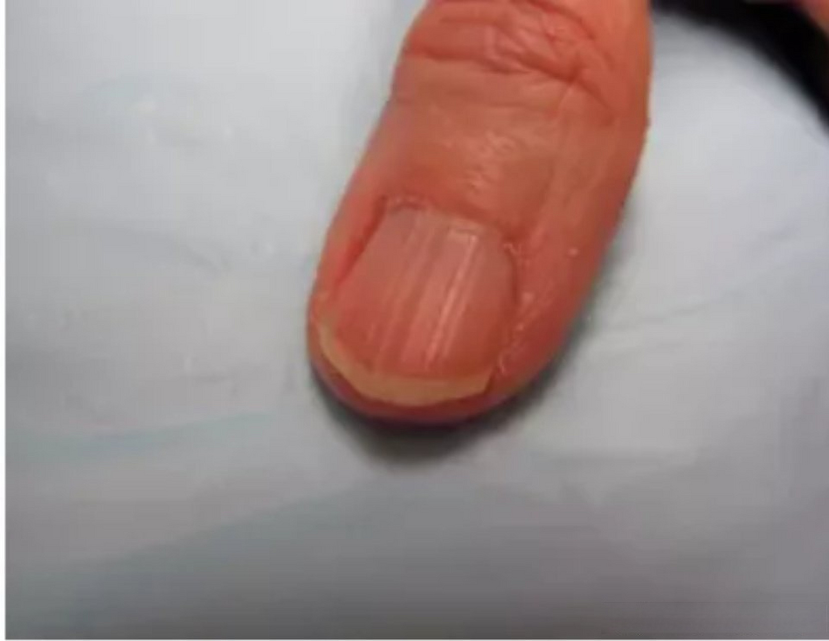 甲纵嵴  甲纵嵴是甲板的纵向隆起和增厚,呈高低不平的粗糙外观,这些甲