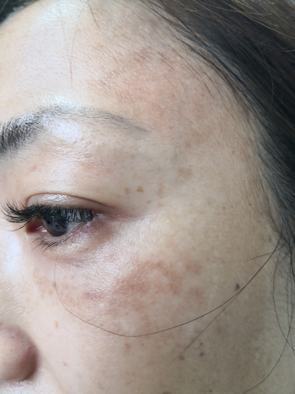 黄褐斑症状黄褐斑 需要系统治疗一段时间能够达到比较好的美容效果