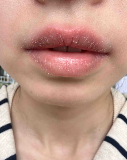 口腔溃疡患者出现嘴唇发干起皮,主要和口腔炎症或上火有关