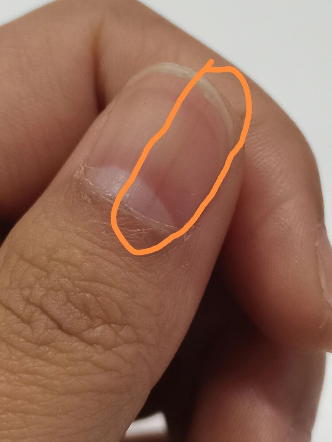 指甲莫名出现一根黑线