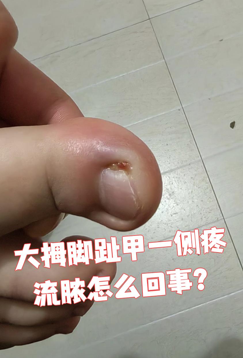 大拇脚趾甲一侧疼痛还流脓,很可能是趾甲周围的化脓性感染,常见致