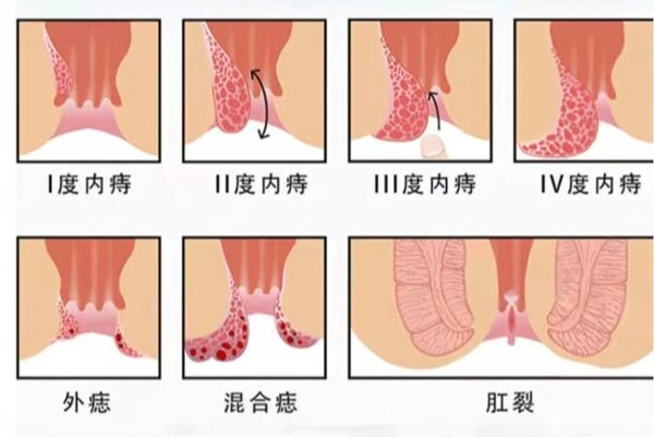 怎样分辨是不是痔疮图片