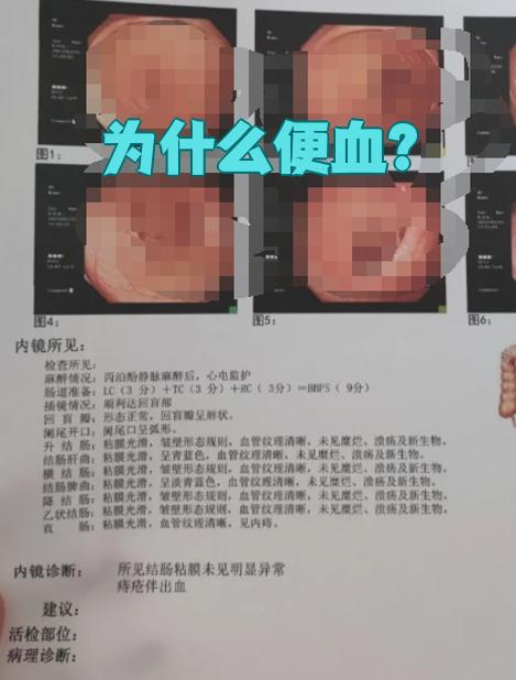 大便为什么会出血 大便为什么会出血