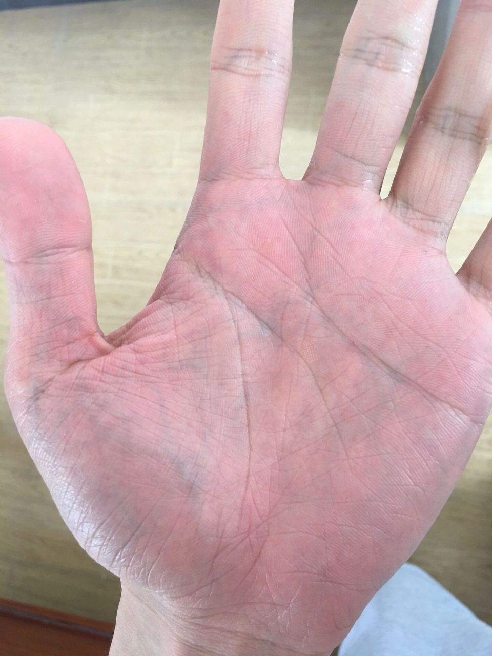 手掌血管发青 手掌血管明显是心脏问题还是贫血体虚?