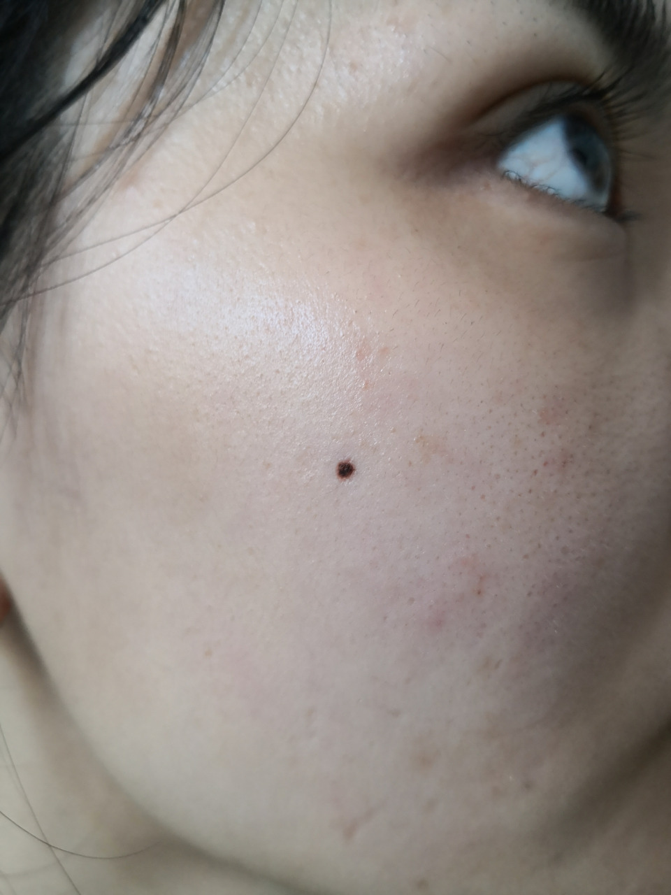 面部色素痣要求治疗.