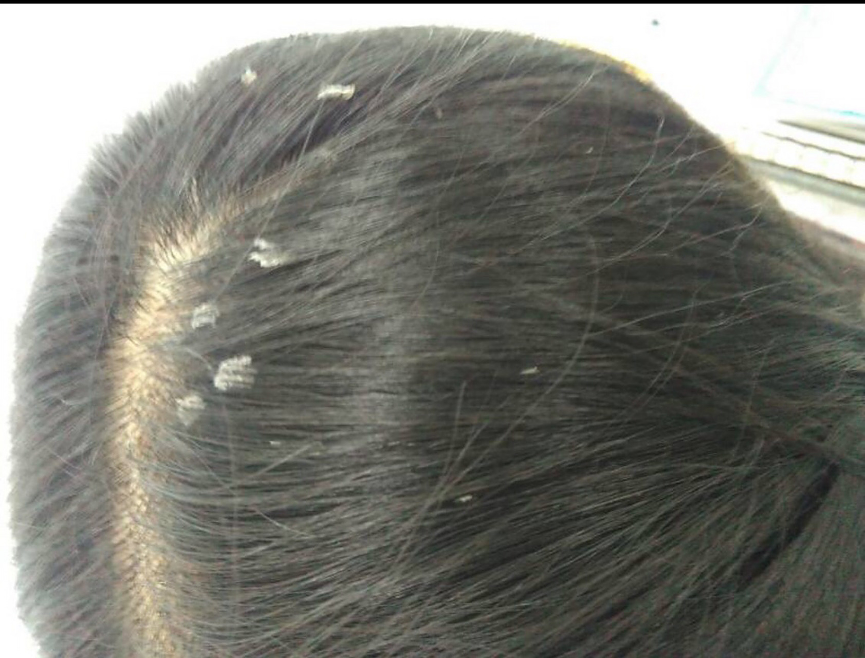 首先,头皮上的痂不一定是头皮屑,有可能是脂溢性皮炎,常分布于皮脂