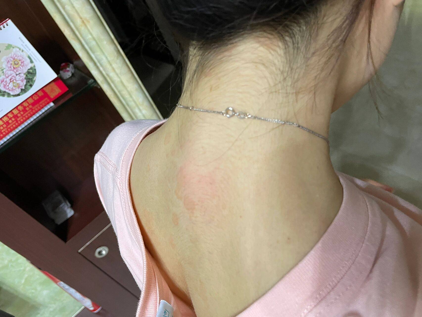 不知道自己得了什么搜后背只有痘痘 后面在小红书看到了原来是汗斑