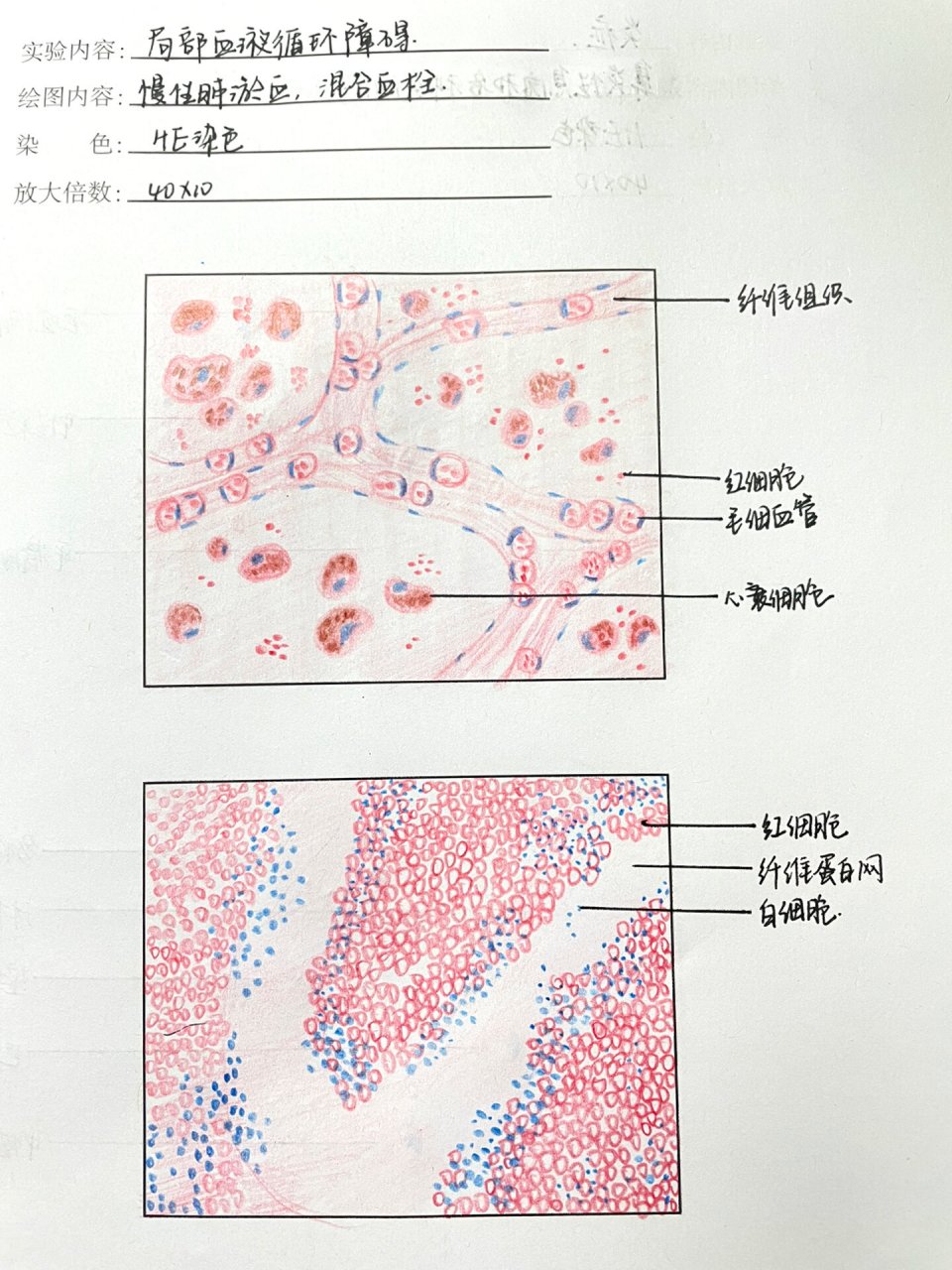 肺淤血镜下图片手绘图片