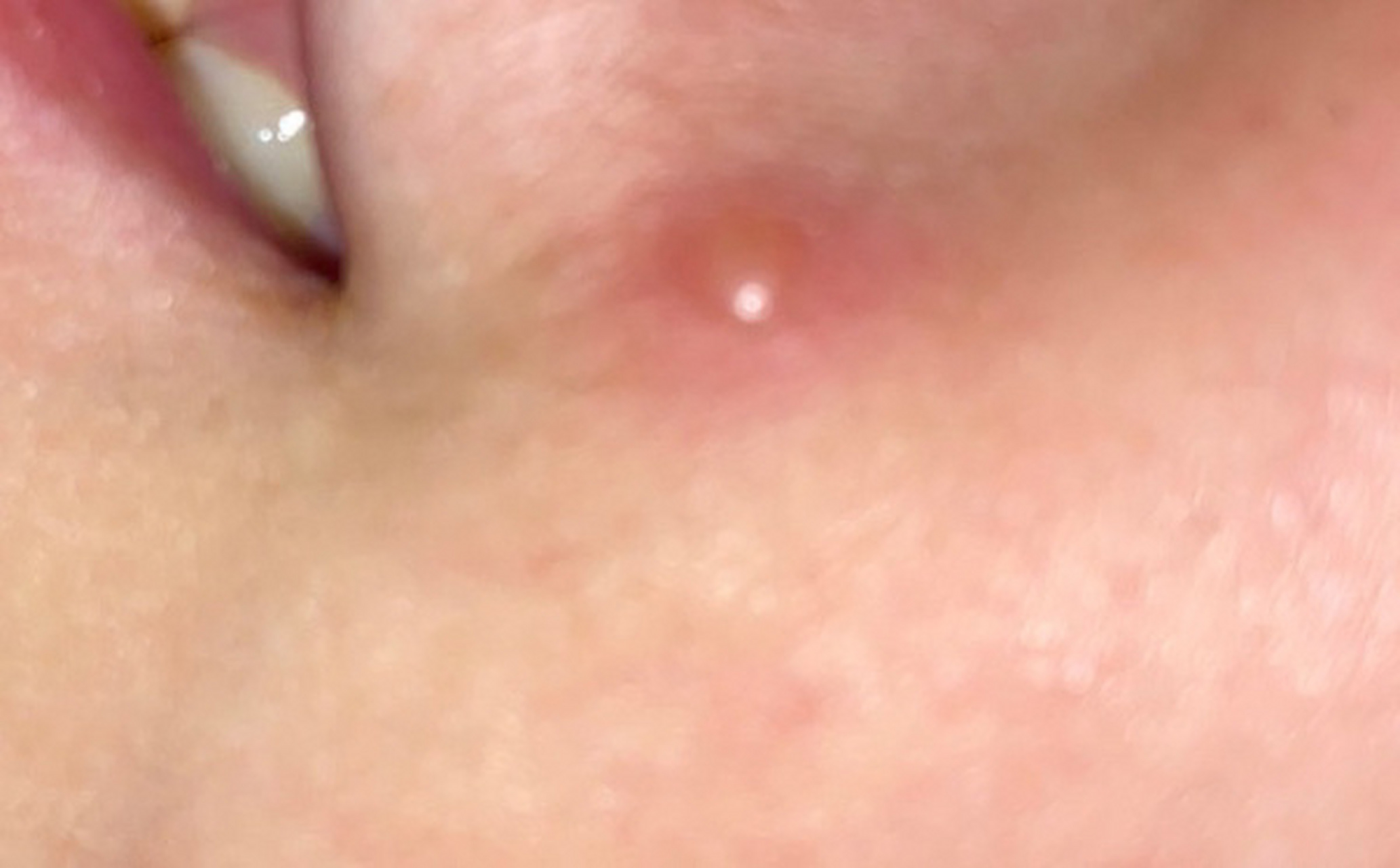 我98副作用特别大,现在孩子是水痘的第五天,症状好转也完全不发烧了