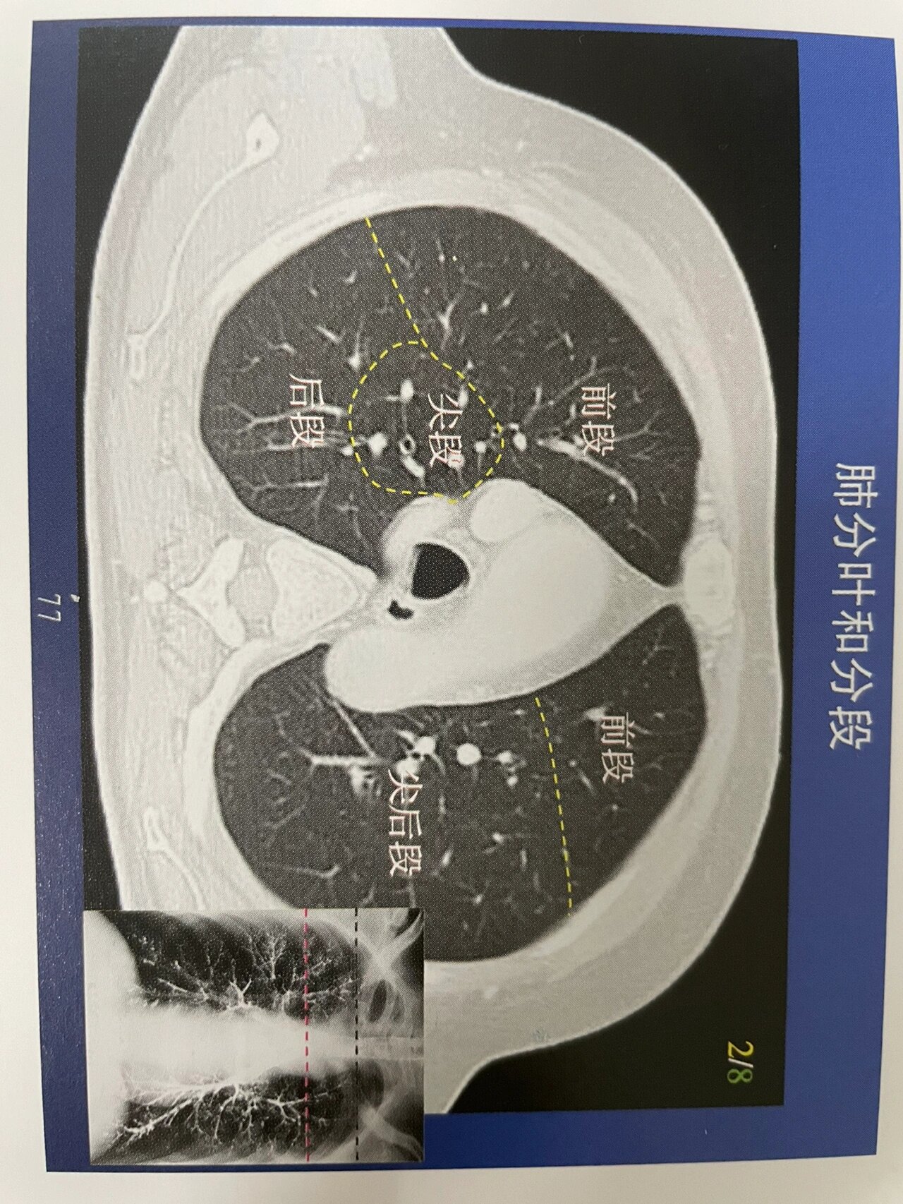 横膈ct图片