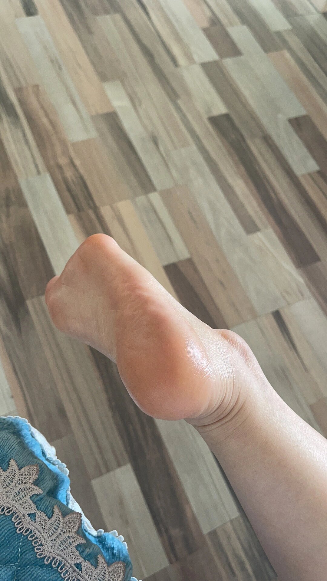 掌跖红斑角化症 痊愈.