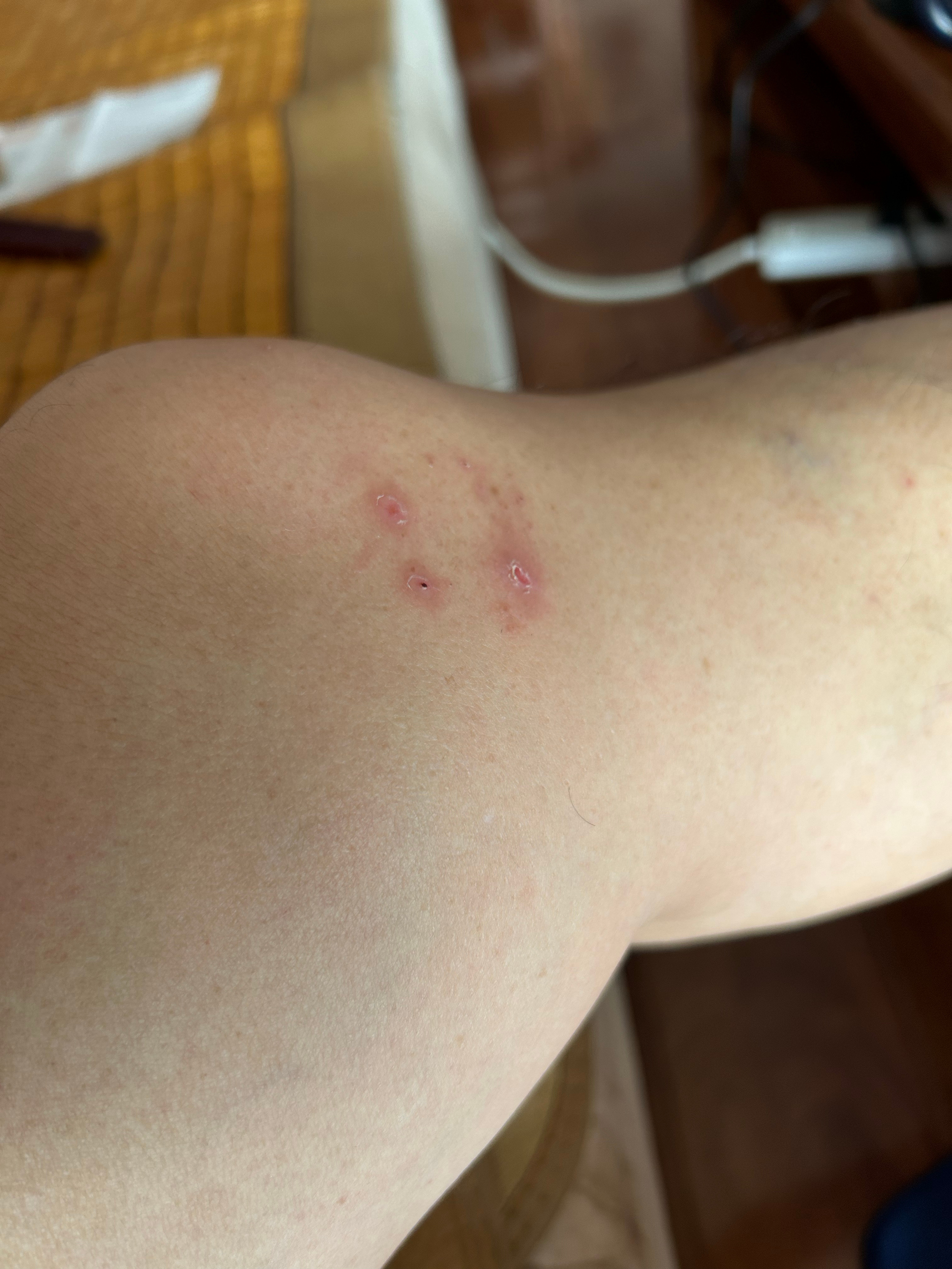 我邻居一下左膝关节附近的水泡,前三四天了,水泡都破了已经结嘎了