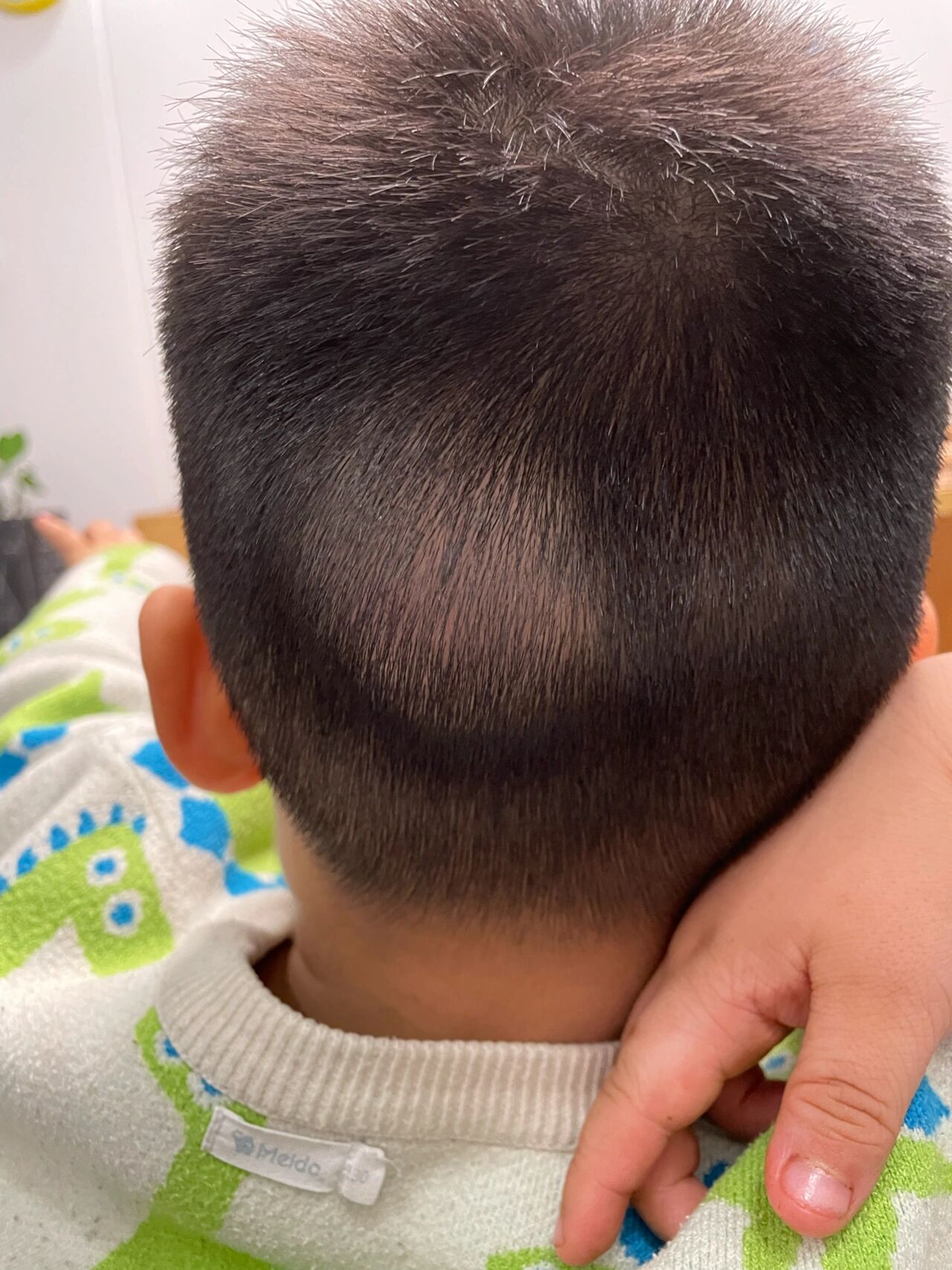 宝宝后脑勺摔伤血肿了 带宝宝出去玩,跟小朋友玩的时候不小心摔倒后脑