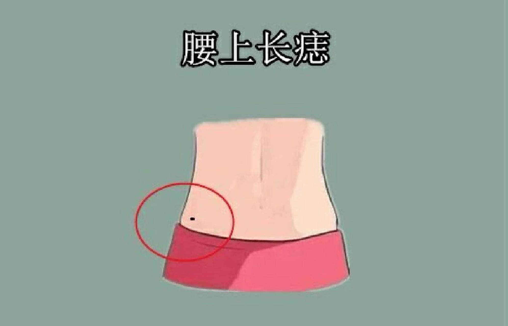 腰上长痣,腰缠万贯 腰上长痣也叫腰缠万贯痣,这颗痣位于腰的两侧,这类