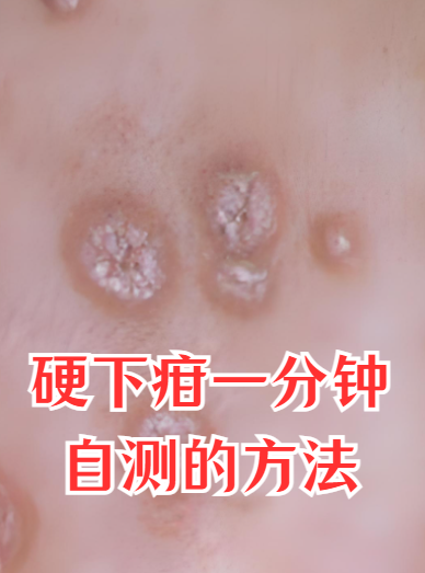 硬下疳一分钟自测的方法