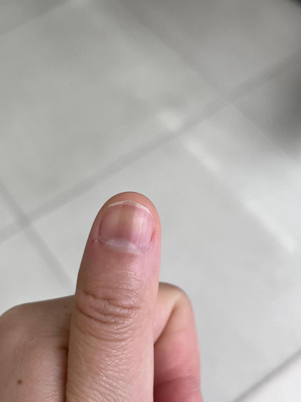 手甲上有黑线是什么回事 大拇指的黑线好几年了,最近另一个手中指也