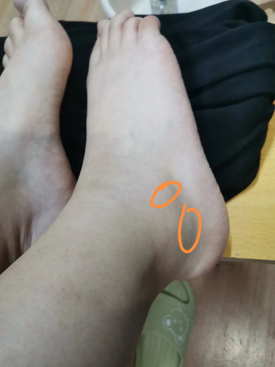 踩空脚崴了没有肿但是疼 上午11点多的时候不小心踩空了,当时感觉有点