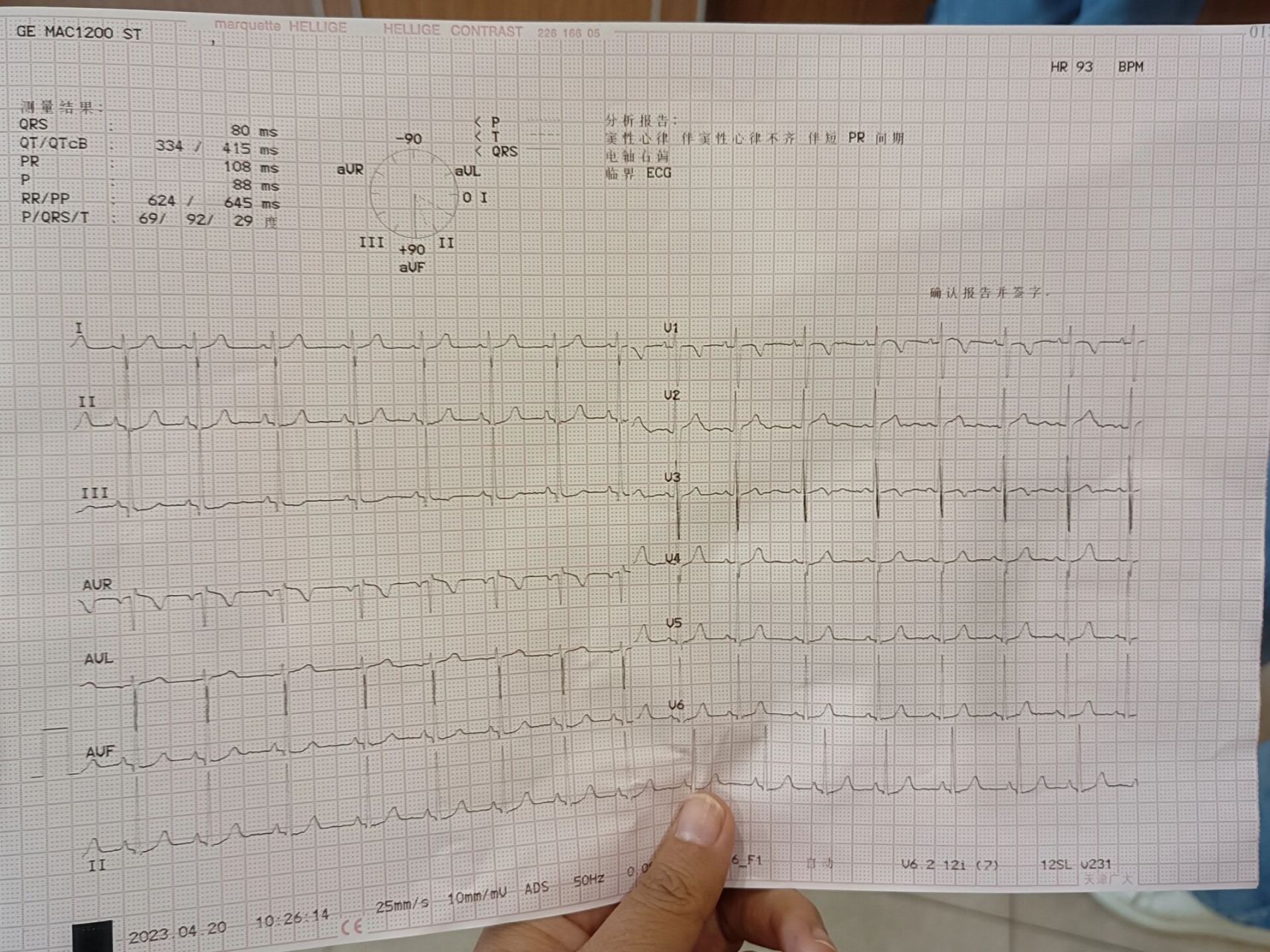 儿童窦性心率不齐伴短pr间期 前期医生判断可能是室上性心动过速,今天