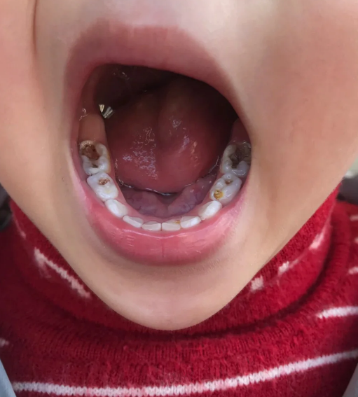 孩子牙齿黑的烂到牙根,最常见的原因是龋齿,牙龈炎或牙髓炎