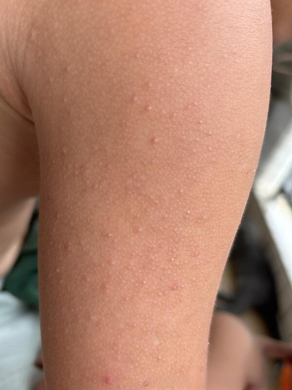 健康美好生活计划#男,11岁, 背部毛周角化,手臂与脸部闭口,类似油脂