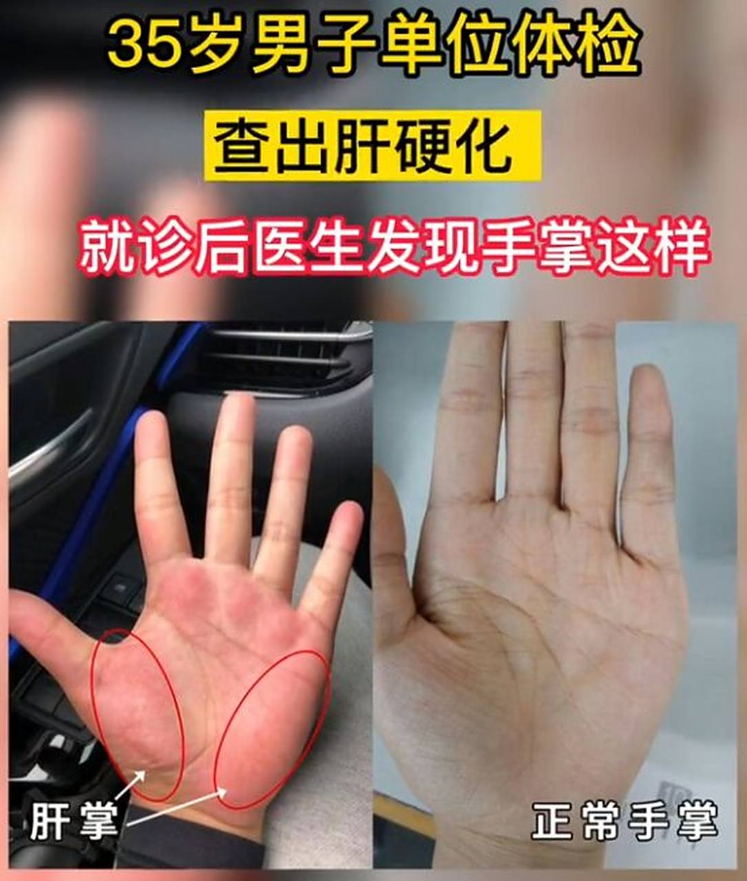 伸出你的手掌看看吧! 常见疾病 慢性乙型肝炎,肝硬化等.