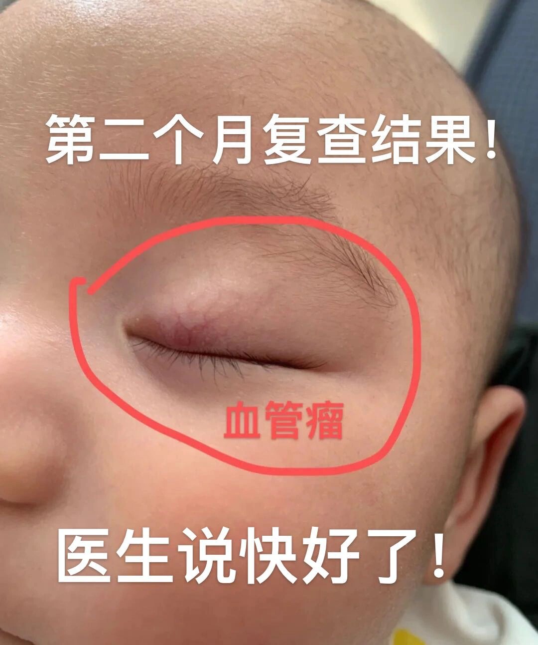 眼皮血管瘤第一次复查,华西医生说快好了!✌️