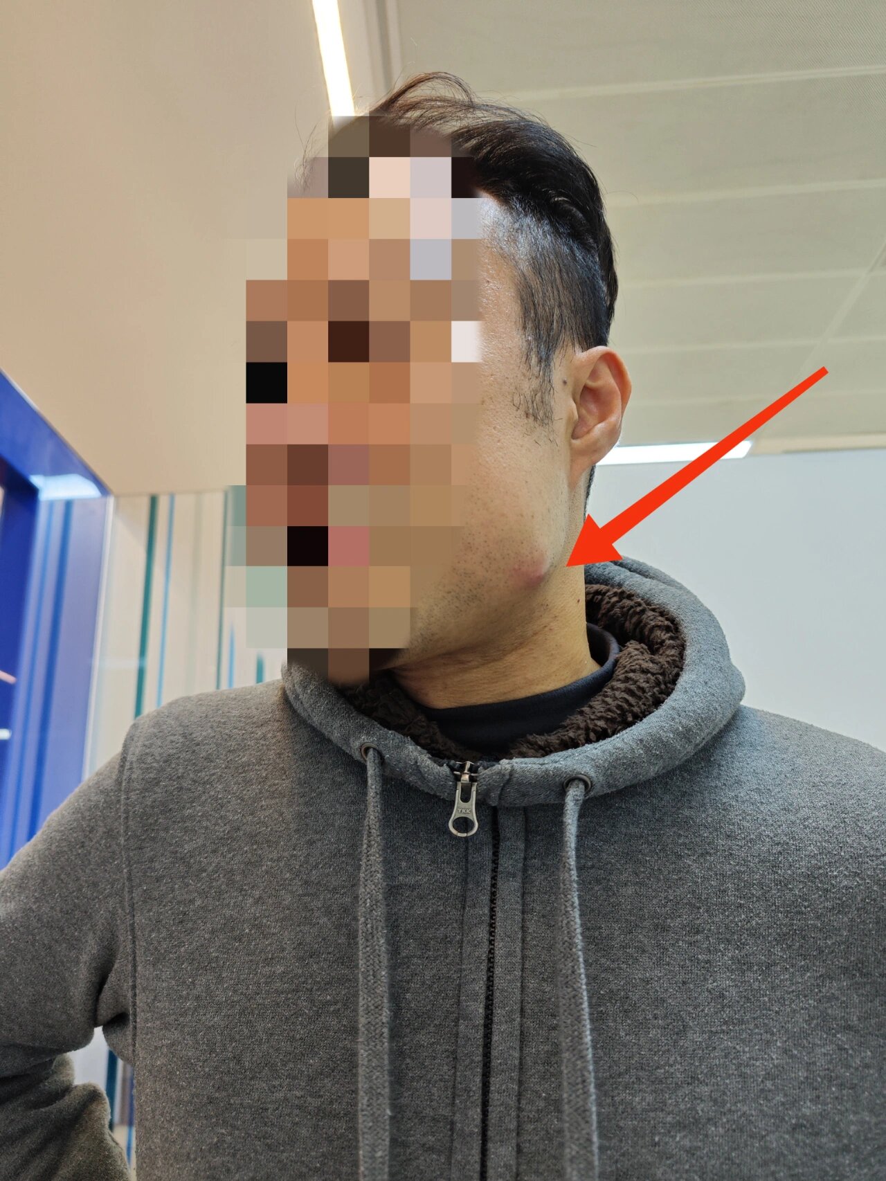 颊瘘,智齿发炎 专业说法, 智齿反复感染,脓液,渗出延下颌骨外斜线在