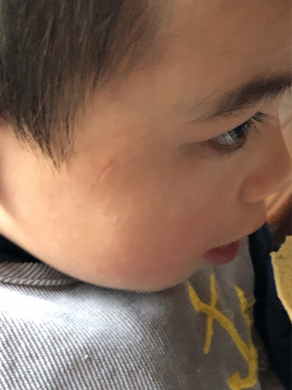 被邻居小孩指甲抓破了,今天一周了,结痂脱落后凹陷了,这种会留疤痕