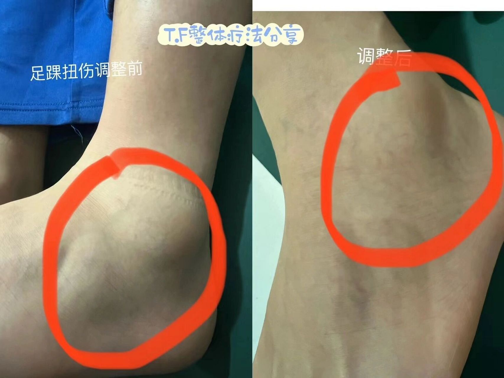 不要小看脚踝扭伤,没有得到及时矫正,就会影响步态,长期下去会造成