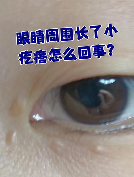 眼睛周围长小疙瘩常见原因有粟丘疹,皮肤过敏,单纯性疱疹等,一般