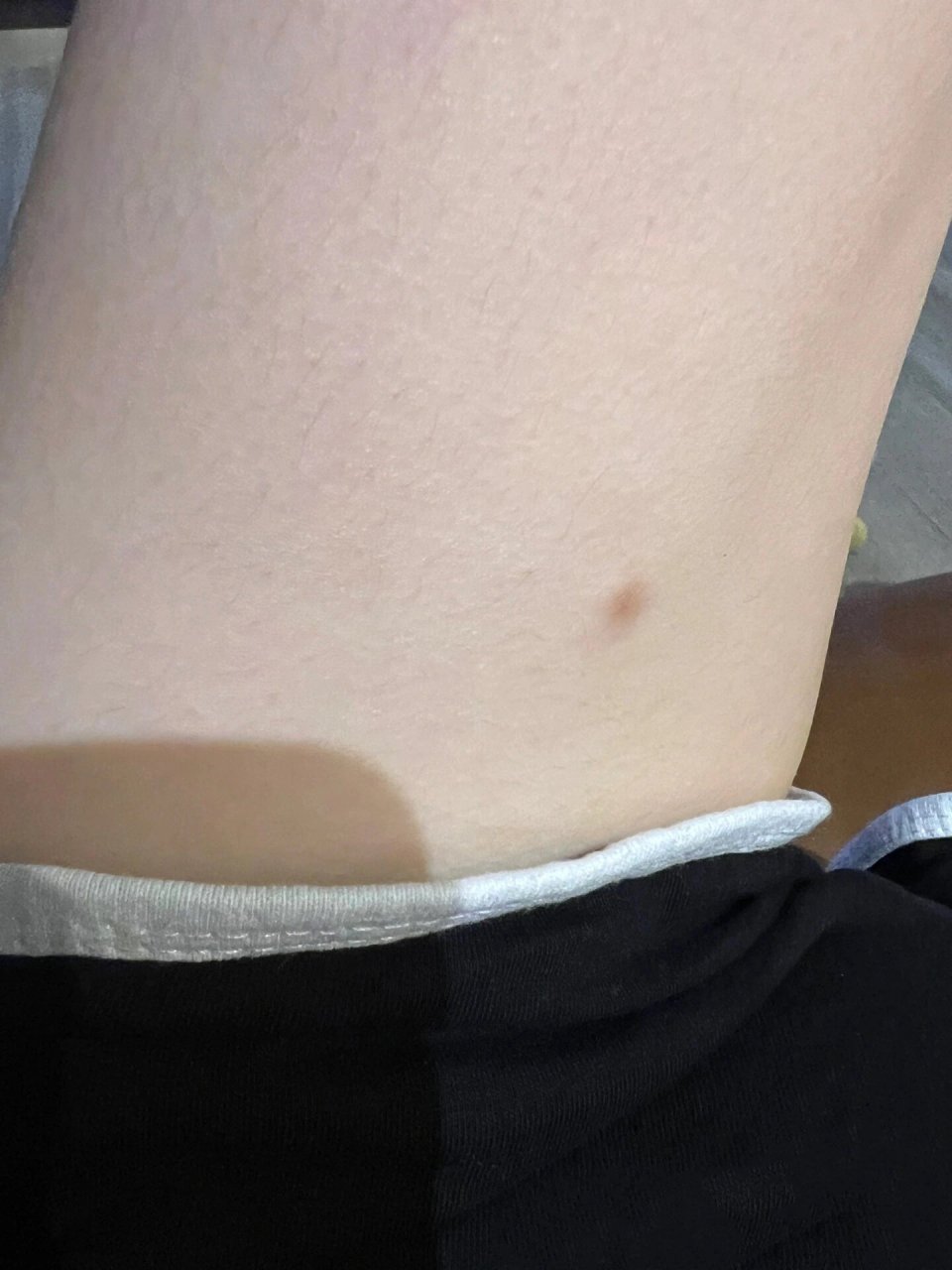 皮肤纤维瘤 大腿内侧长了一个纤维瘤,摸起来里面有点硬,长了两年多了