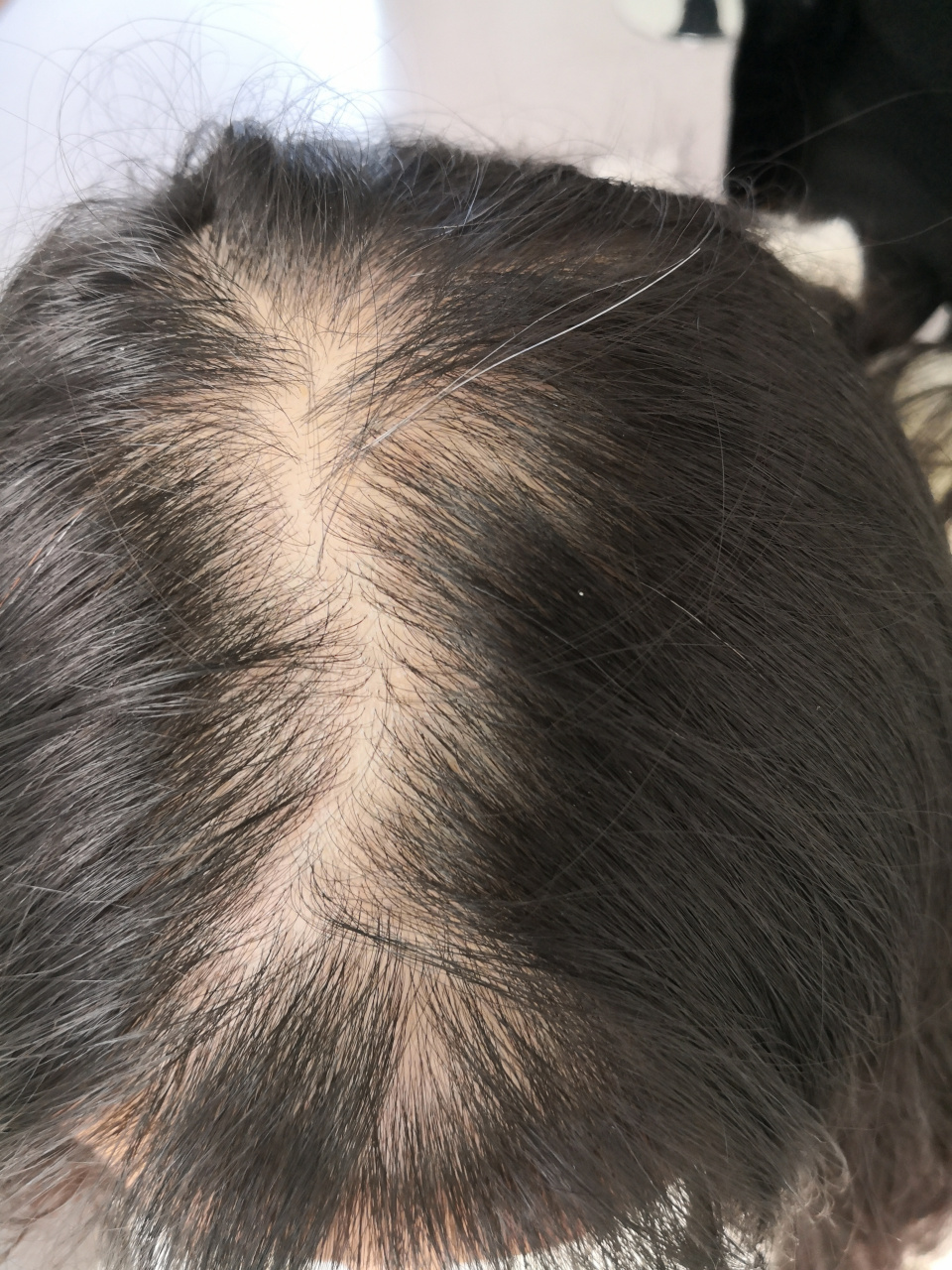 女性雄激素性脱发,女性型脱发.#脱发##雄激素性脱发