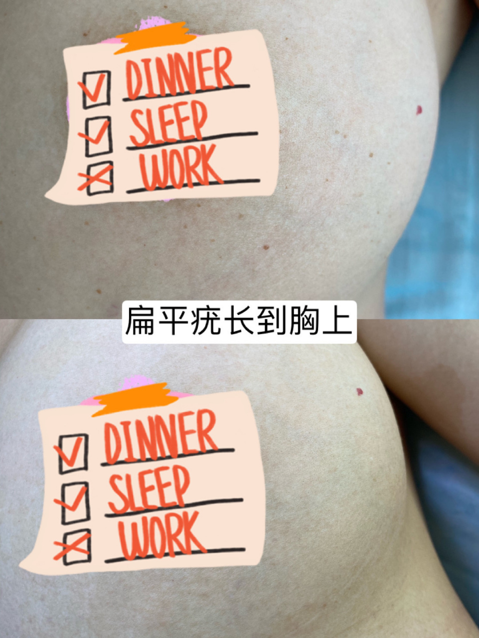 乳房上长扁平疣怎么办图片