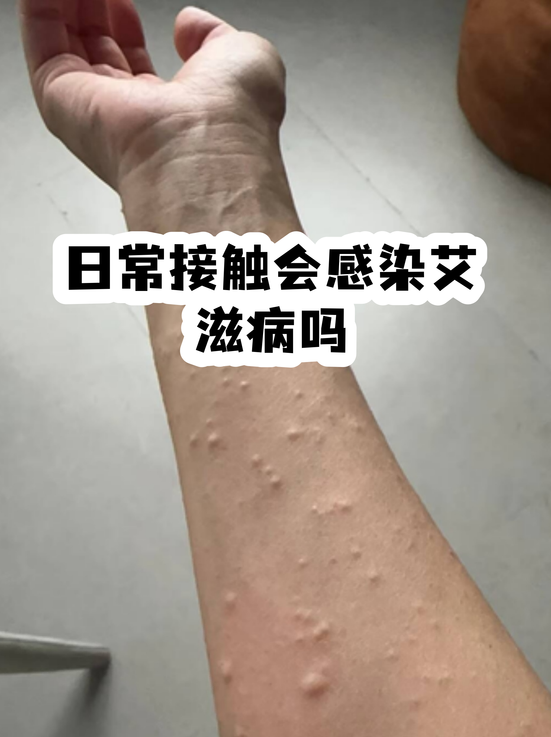  注射病毒会传染什么病(疫苗里的病毒会传染么)