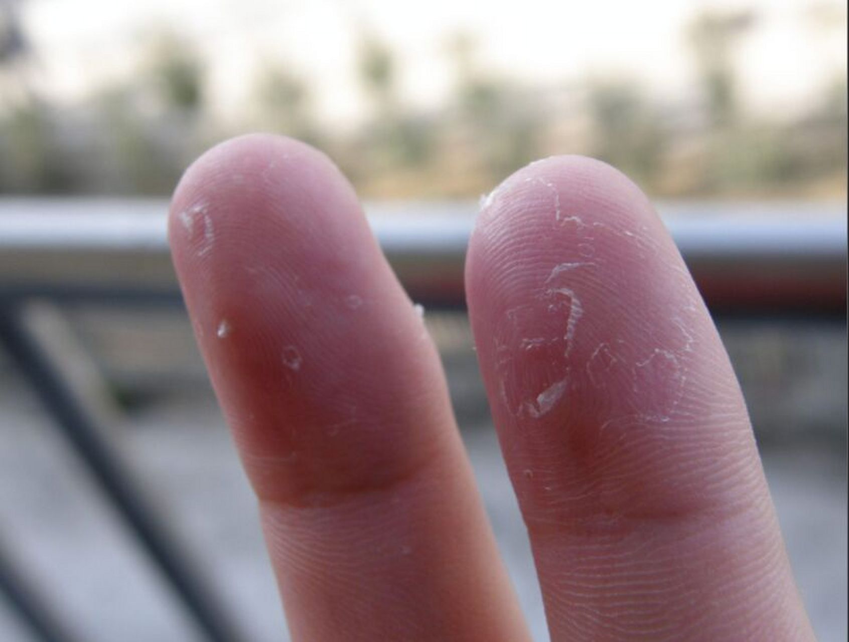 手指总脱皮? 缺维生素or皮肤病?