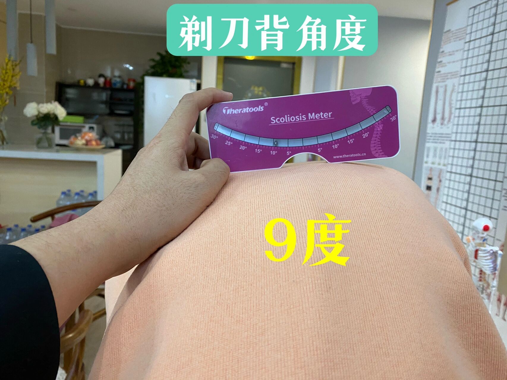 剃刀背 今天有接一位脊柱侧弯孩子,剃刀背非常明显