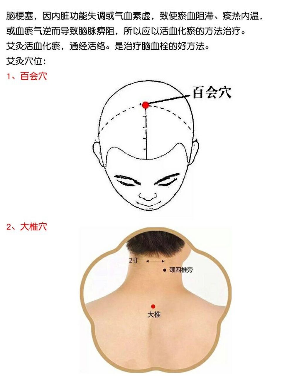 脑梗艾灸哪个部位图图片