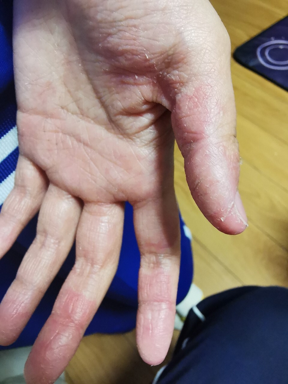 孩子的手周期性的脱皮严重怎么办 孩子十岁,从三岁开始,手部季节性的